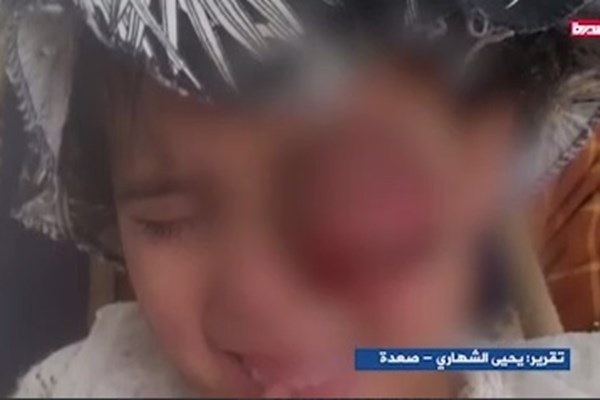 افزایش ابتلای کودکان یمنی به سرطان در نتیجه سلاح های ممنوعه متجاوزان - تصویر دوم خبر