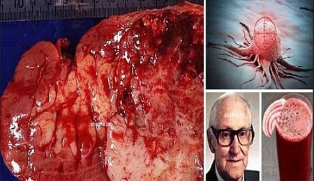 سرطان را تنها با نوشیدن این معجون درمان کنید!! - خبرگزاری افغان ایرکا