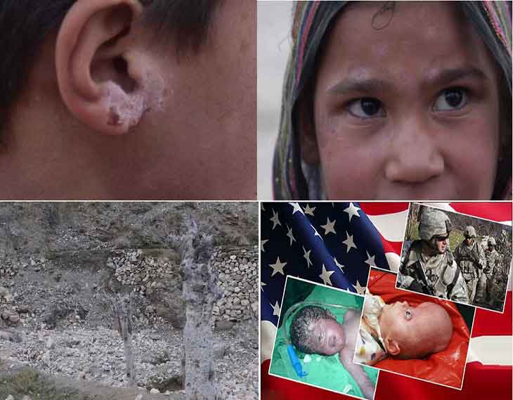 مریضی های جلدی، عوارض بمب های آمریکایی (عکس) - خبرگزاری افغان ایرکا